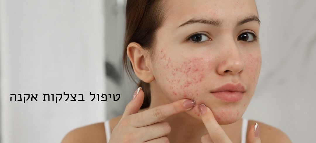 טיפול בצלקות אקנה