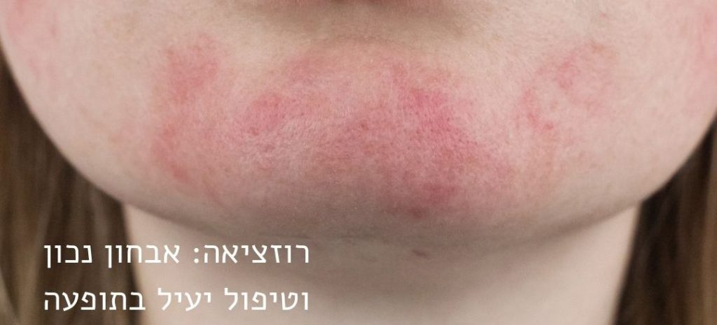 רוזציאה - rosacea