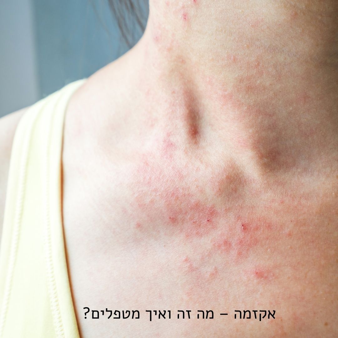אקזמה – מה זה ואיך מטפלים?