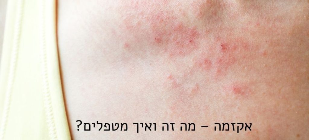 אקזמה