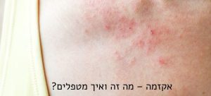 אקזמה