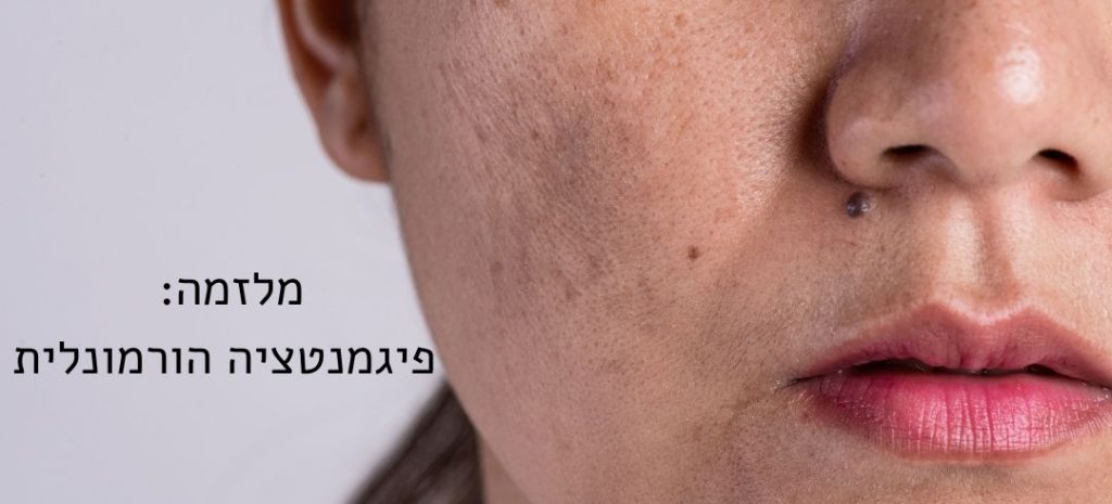 מלזמה - פיגמנטציה הורמונלית