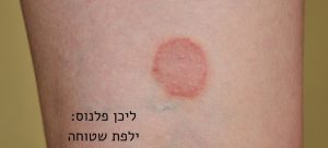 ליכן פלנוס - ילפת שטוחה