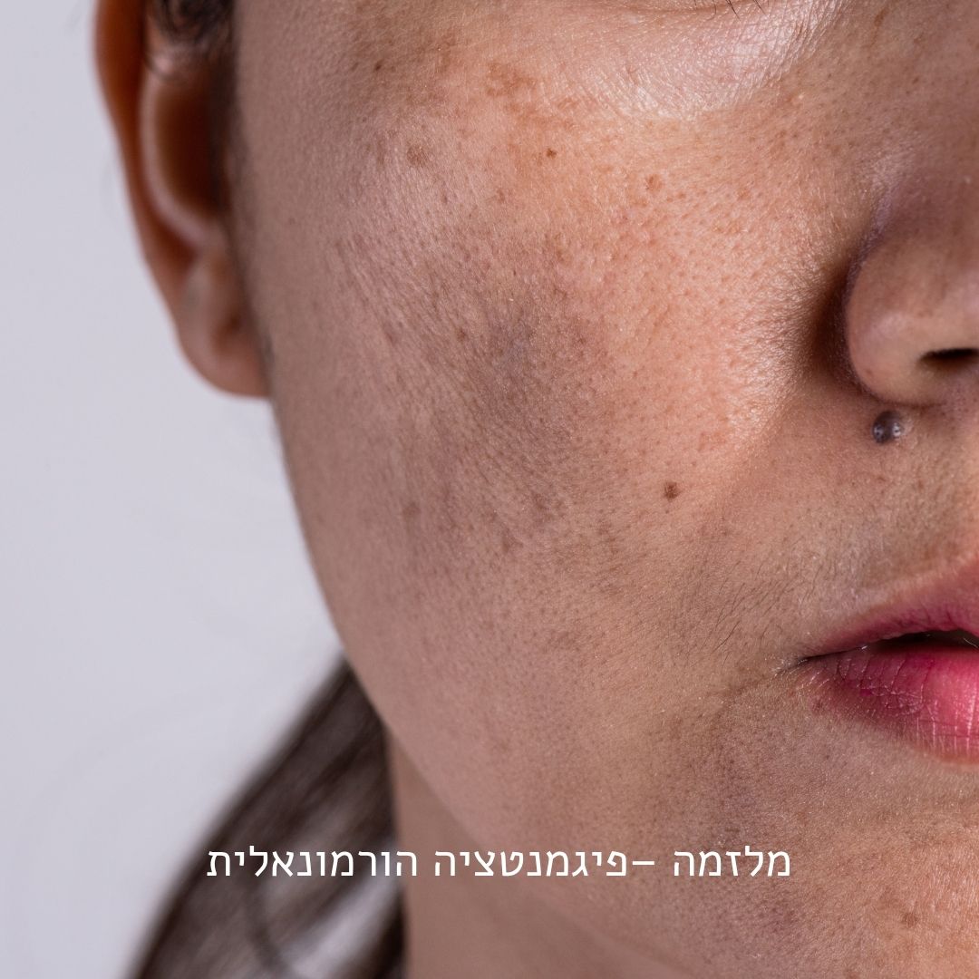 מלזמה פיגמנטציה הורמונלית