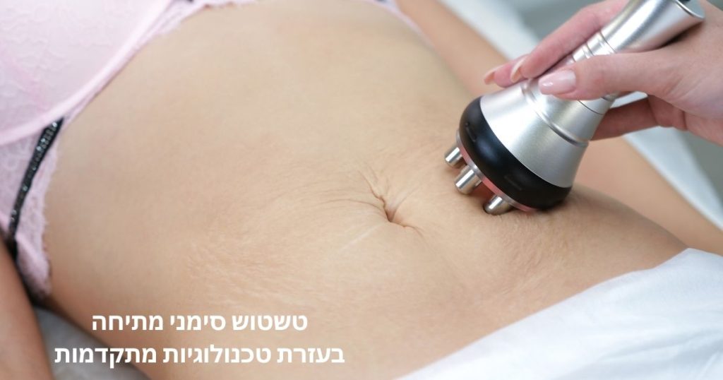 טשטוש סימני מתיחה
